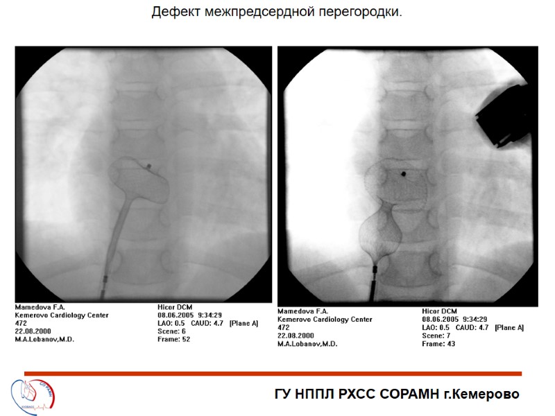 ГУ НППЛ РХСС СОРАМН г.Кемерово Дефект межпредсердной перегородки.